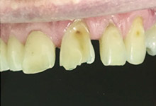 Beispiel 2 Korrektur abgebrochener Schneidezähne / Vorher